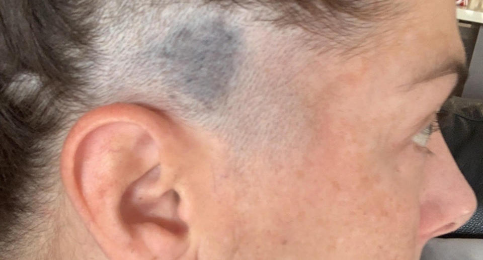 The bruise-like mole spotted by Lee King's hairdresser.