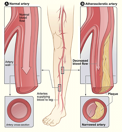 peripheral artery disease