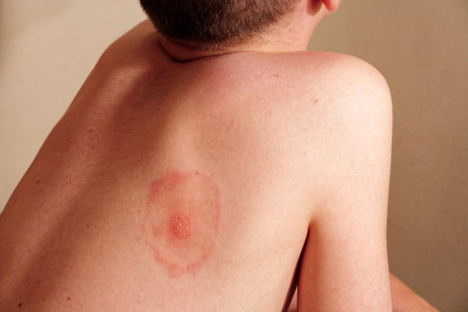 Lyme disease patient with characteristic bulls-eye rash. (Alamy)