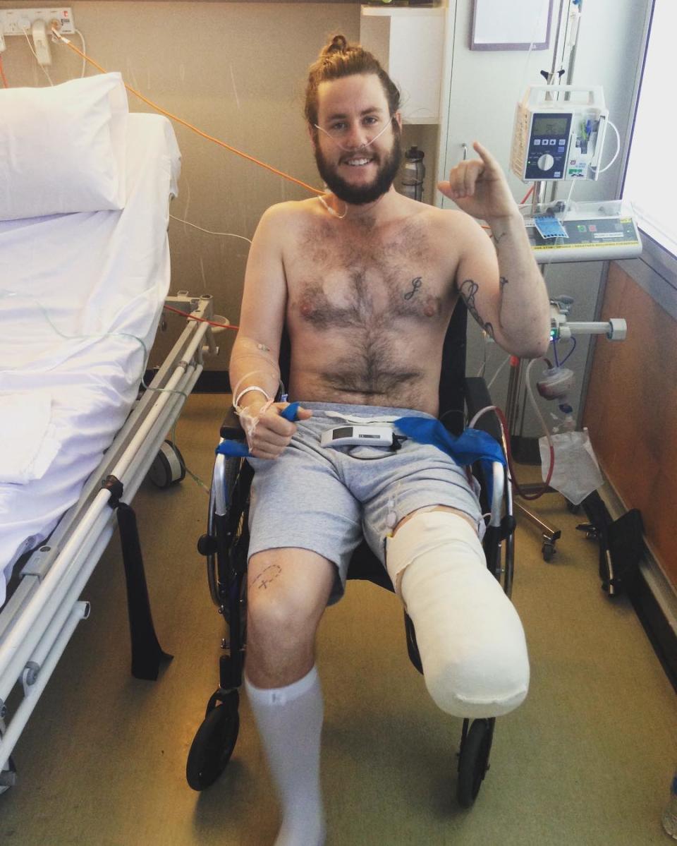 Jed Altschwager sitting in a wheelchair with a bandaged leg after having his lower leg amputated