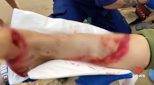 The woman suffered a severe bite and deep cuts to her right leg, with flesh ripped off the bone. Source: 7 News