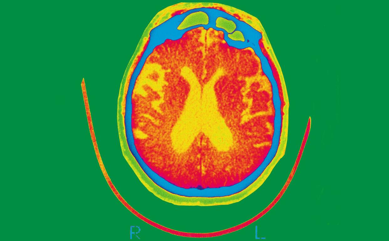 <span>Scans such as MRIs can be used to check for changes to the brain.</span><span>Photograph: Bsip Sa/Alamy</span>