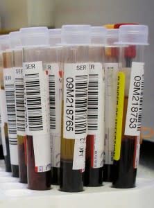 Can Doctors Diagnose MS from Blood?