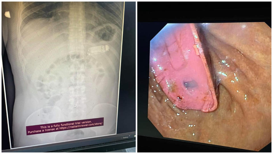 醫師透過X光片發現手機卡在肚子內。（圖／翻攝自Skender Telaku臉書）