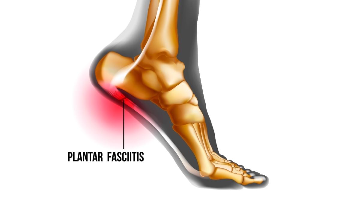 Insoles for High Arches and Supination: 2 Practical Solutions