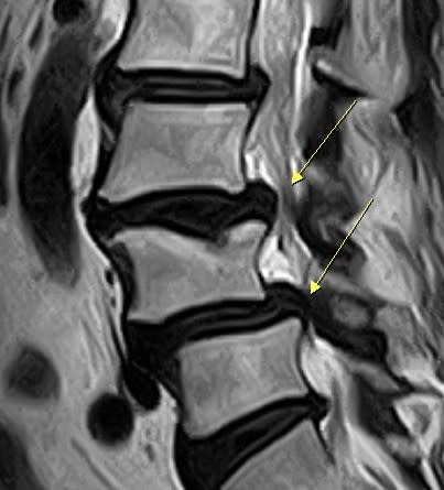 患者腰椎第3至4至5節連續椎間盤突出且合併脊椎滑脫，致下背及雙大腿嚴重痠痛，右腳趾亦麻刺。（記者王正平翻攝）