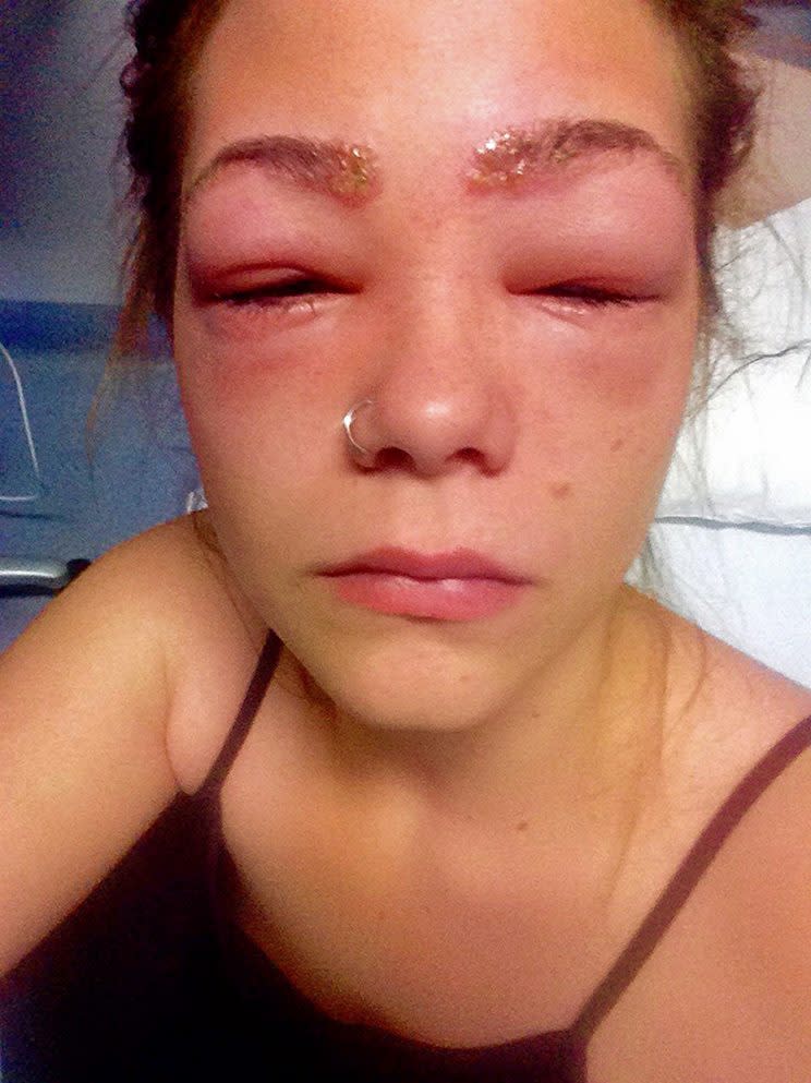 Durie’s allergic reaction to at-home dye. (Photo: Caters News)