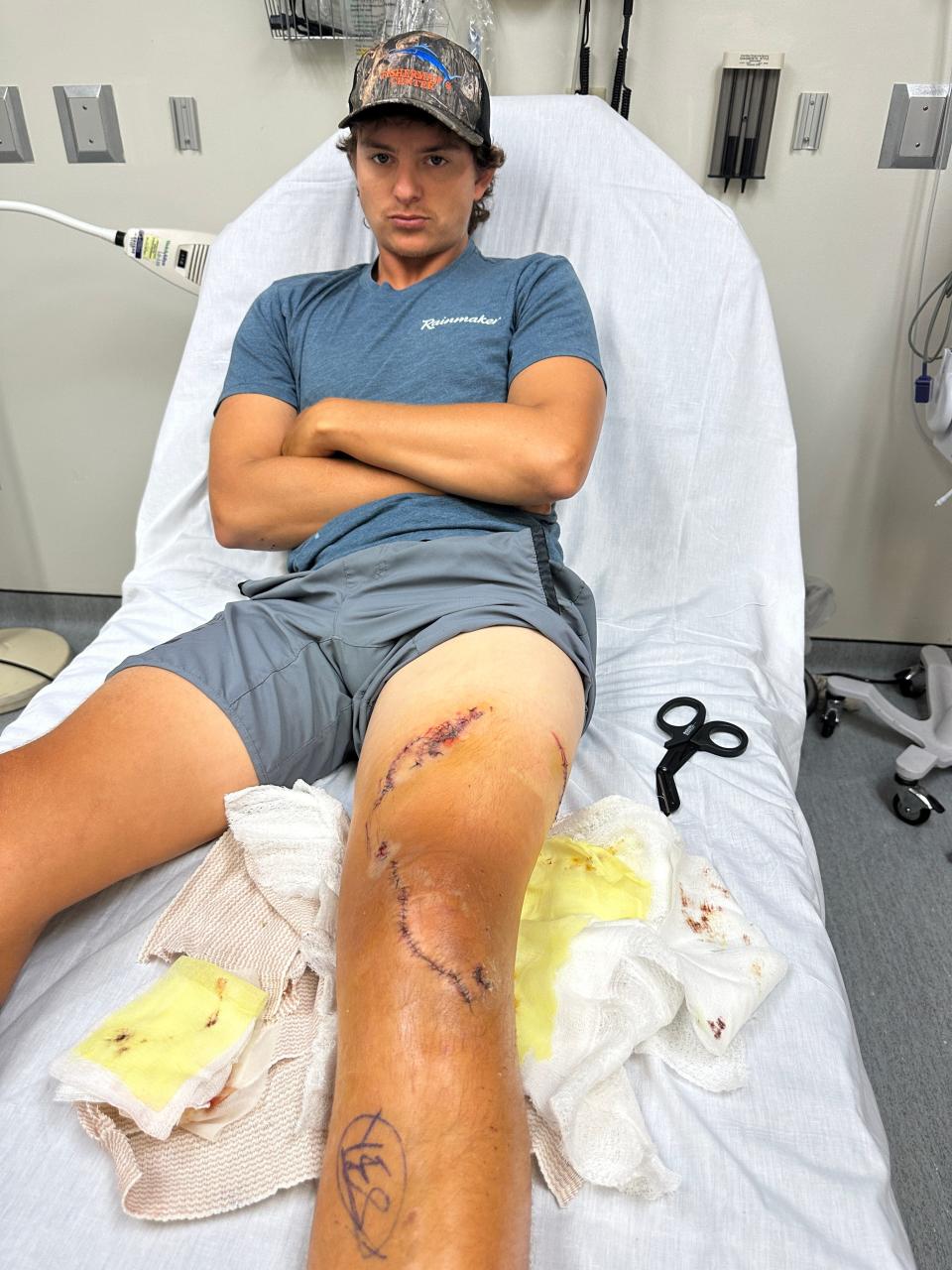 Marlin Wakeman, after being bitten by Carribean reef sharks after he slipped and fell into the water in the Bahamas in 2024.