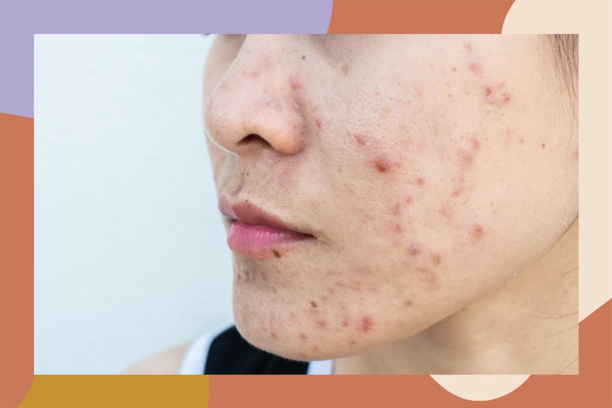 cystic acne