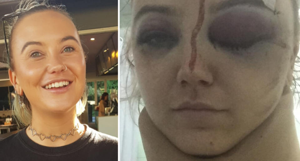 Emma Bell suffered serious head injuries in the attack. Source: GoFundMe