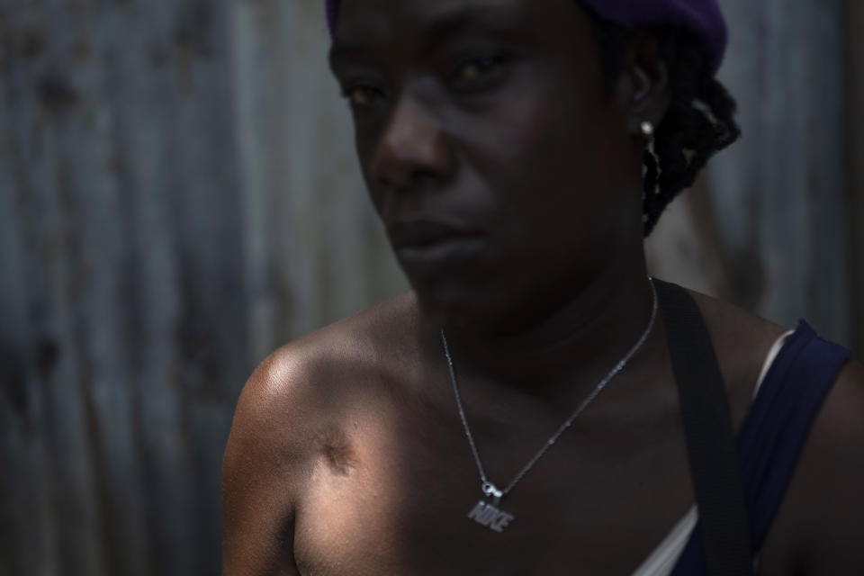 A ray of light illuminates a bullet wound on Rose Dufond's right shoulder as she poses for a picture at a shelter in Delmas, in Port-au-Prince, Haiti, Sunday, June 4, 2023. Dufond says she was nine months pregnant when gang members shot her in the shoulder then beat and raped her, causing her to miscarry. (AP Photo/Ariana Cubillos)