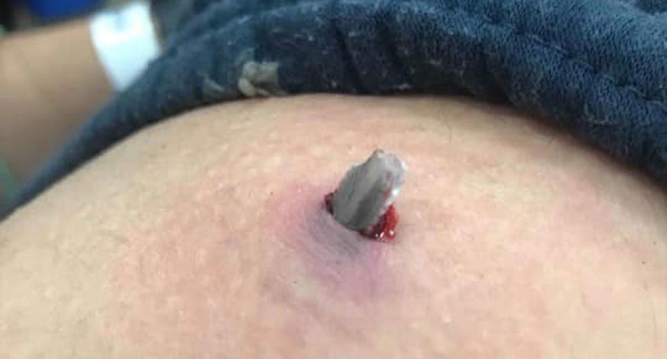 A stingray barb stuck in a man's hip. A Perth fisherman was recently struck by a stingray barb on trying to unhook a ray.