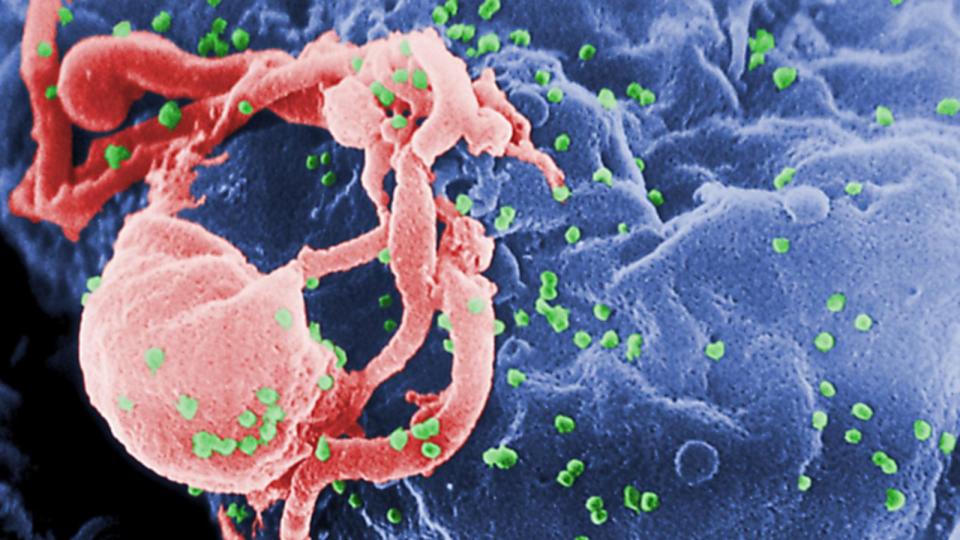 PHOTO: In this 1985 file photo, a scanning electron micrograph (SEM) shows HIV-1 virions as green round bumps budding from the surface of a cultured lymphocyte cell. (Smith Collection/Gado/Getty Images, FILE)
