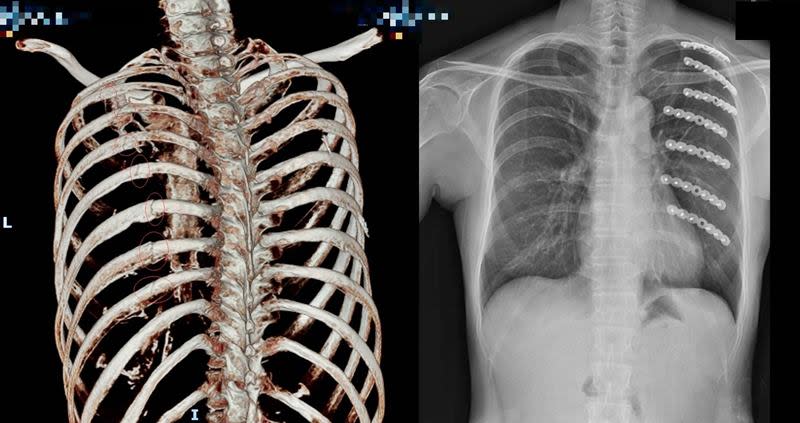 車禍肋骨斷7根要手術卻確診　被新冠肺炎擔誤7天微創重生