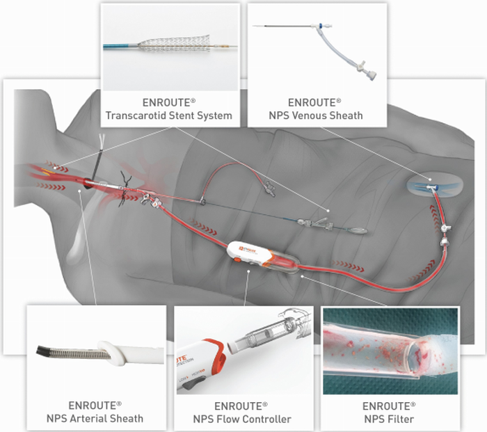 Illustration of a Silk Road ENROUTE system in surgical use.