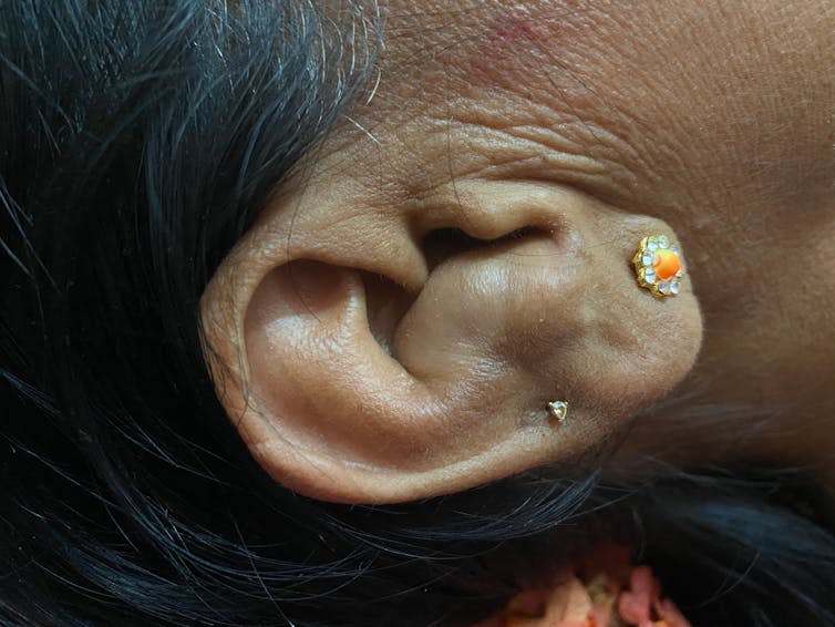 A close up of a woman's cauliflower ear