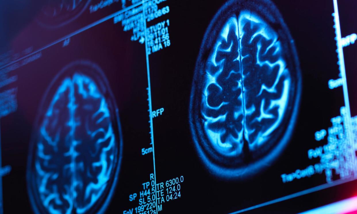<span>Frontotemporal dementia affects the part of the brain responsible for skills such as the capacity to plan ahead and control impulses.</span><span>Photograph: Andrew Brookes/Getty Images/Image Source</span>