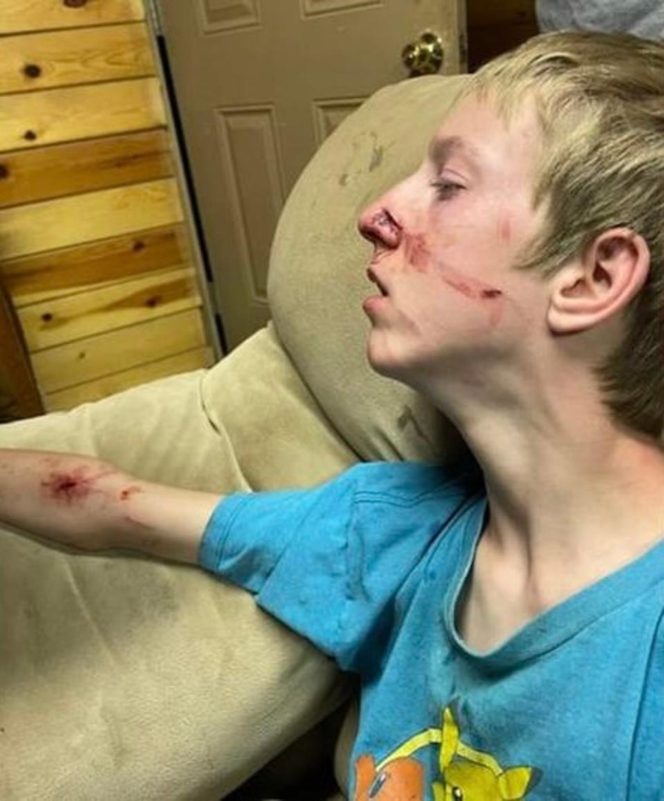 Fifteen-year-old Brigham Hawkins was attacked by a bear while camping with his family last week in Arizona (Judith Hawkins)