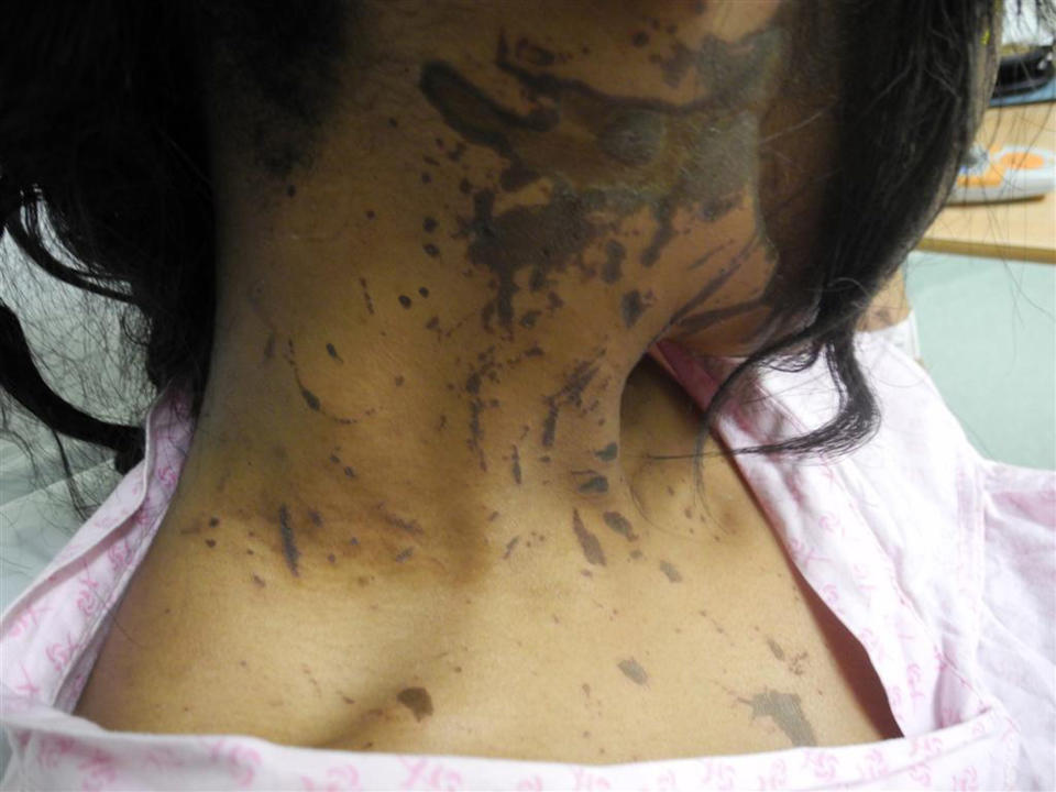 Many acid attack victims suffer life-altering scarring (SWNS)