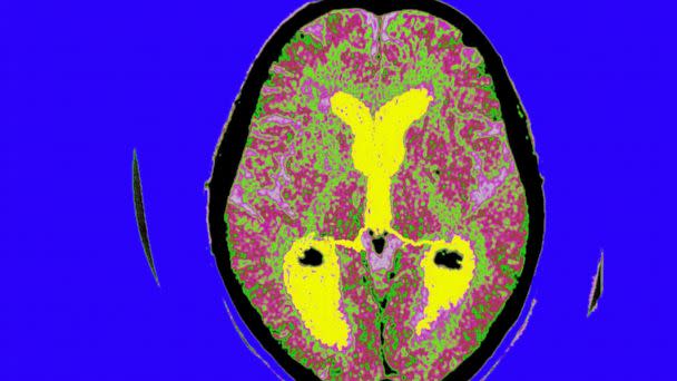 PHOTO: A brain scan of a patient affected by Alzheimer's disease. (BSIP/Universal Images Group via Getty Images)