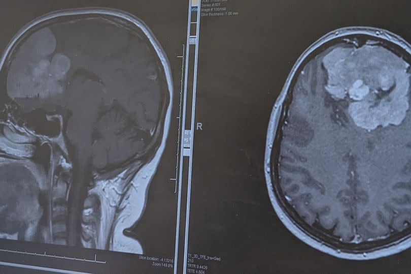 Caroline's scan showing her brain tumour