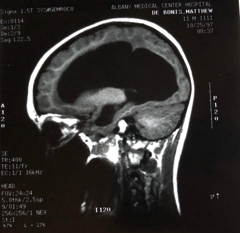 MRI image of Matthew's tumor