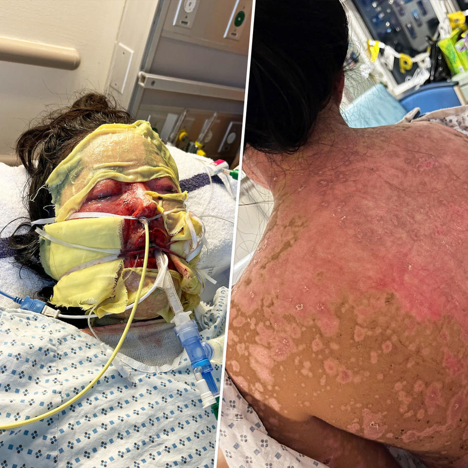 The disease caused blisters that left second-degree burns across Stella Shon's body. (Courtesy Stella Shon)