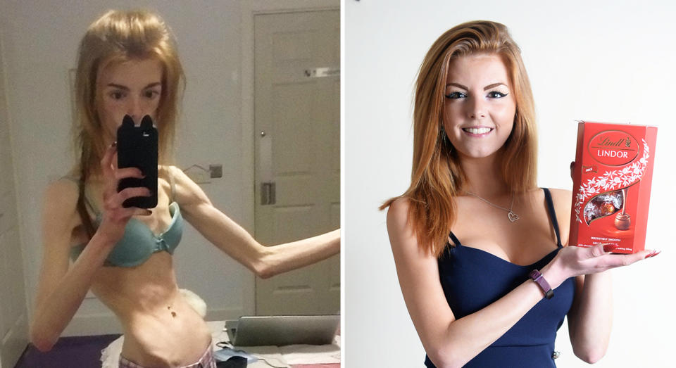 Annie weighed 29kg at the height of her anorexia. [Photo: SWNS]