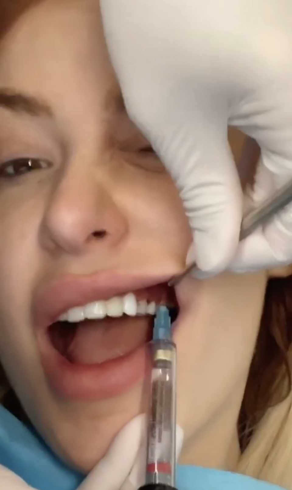 Close-up of Tana's open mouth as her gum gets an injection