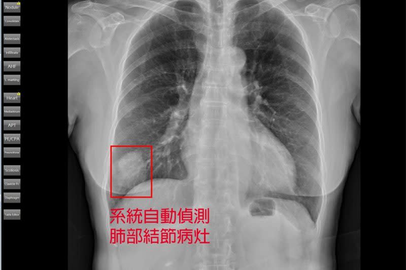 AI自動判讀胸腔X光片。（亞東醫院提供）