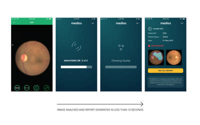 Automated Diabetic Retinopathy detection by The World's first offline AI