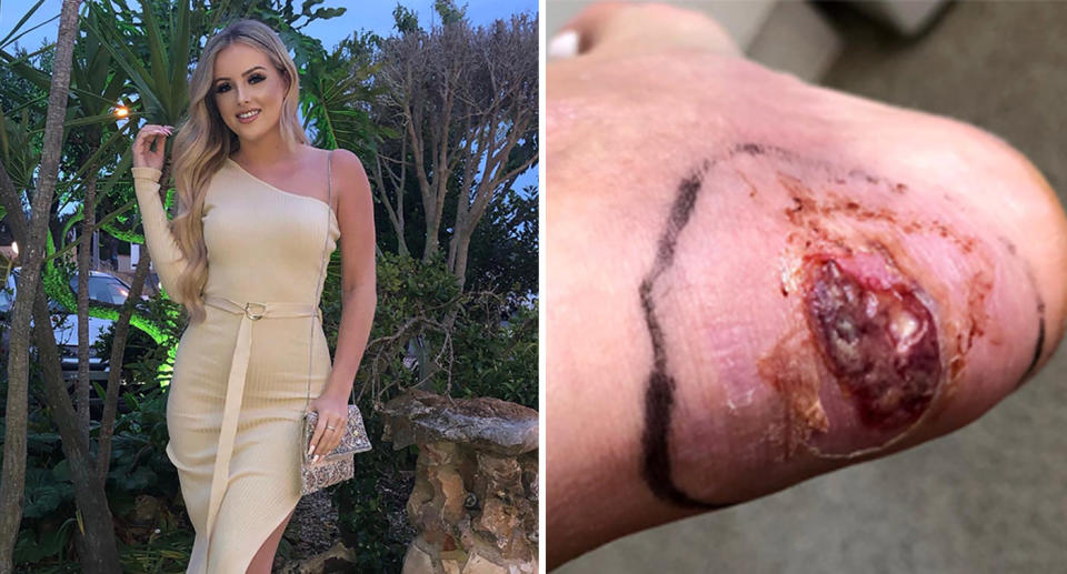 Gemma is speaking out, warning others how a subtle injury can turn into a potentially deadly infection after she bought some cheap shoes. Source: Caters