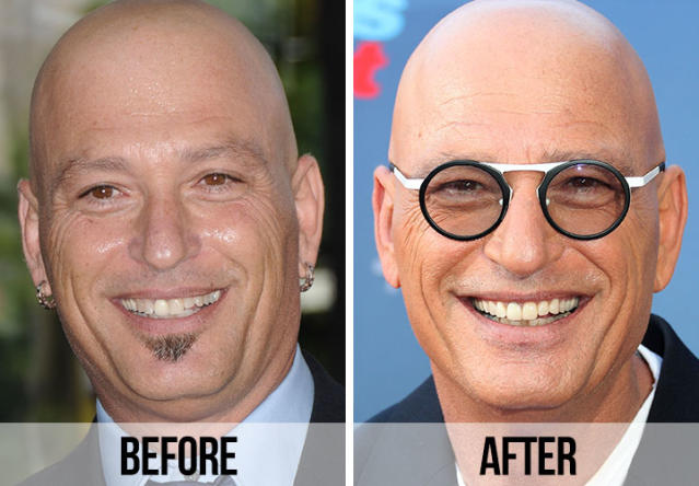 21 Celebrity Dental Implants And Veneers: Before And After - SHEfinds