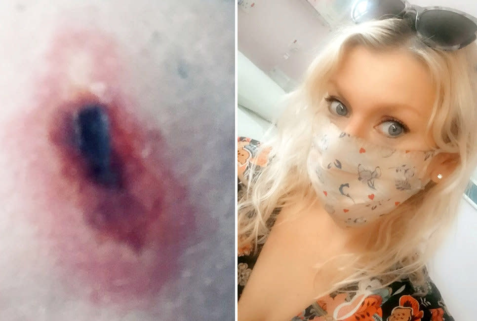 Jo Kenyon was hospitalised three times after she was bitten by a spider lurking under the loo seat. (SWNS)