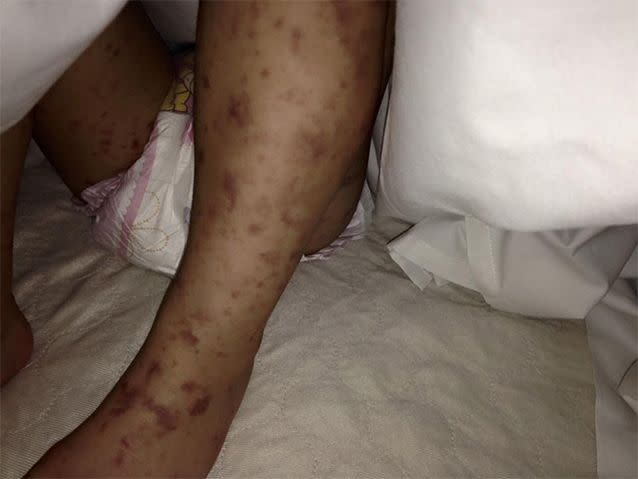 Jazmyn's legs covered in dark spots, which mother Sarah was shocked to hear was dead tissue from meningococcal B. Photo: Facebook/Jazmyn's meningococcal B journey