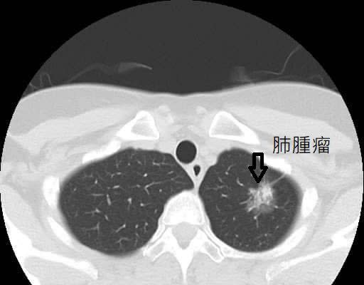 國民健康署表示，肺癌篩可揪出早期個案。   圖：取自衛生福利部桃園醫院