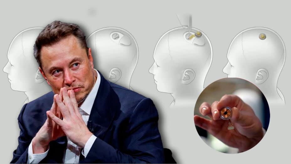 Elon Musk asegura que Neuralink ya implantó un chip cerebral en un ser  humano