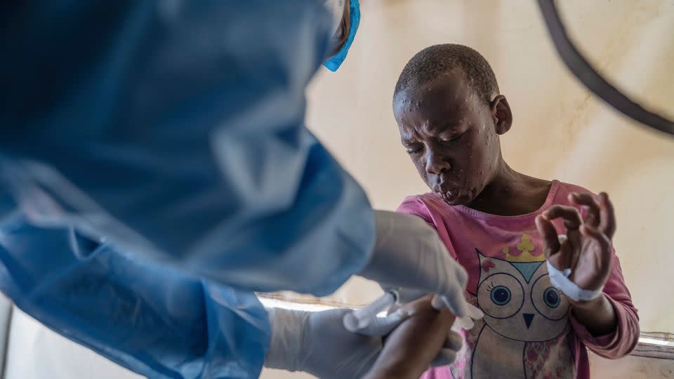 A health worker attends to an mpox patient in Munigi, eastern Congo, on August 19, 2024. - Moses Sawasawa/AP