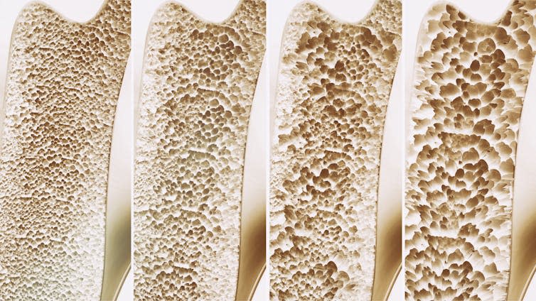 The interior of bones, showing four depictions of bone density – from healthy to severe osteoporosis.