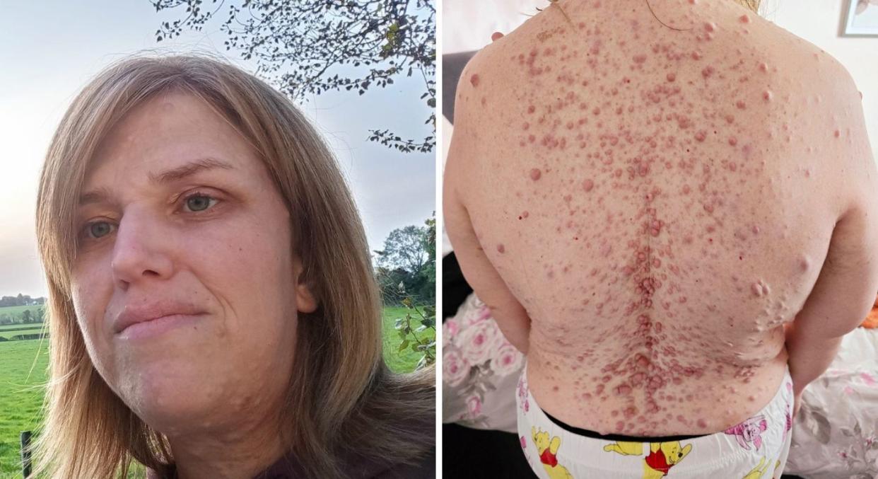 Rachel Potter suffers from neurofibromatosis type 1, which means she has thousands of tumours over her body. (Rachel Potter/SWNS)