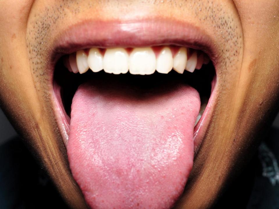 Swollen tongue