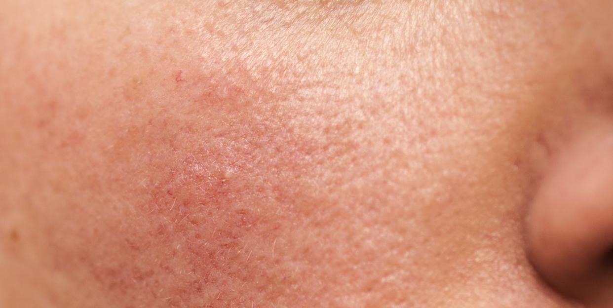 rosacea on skin