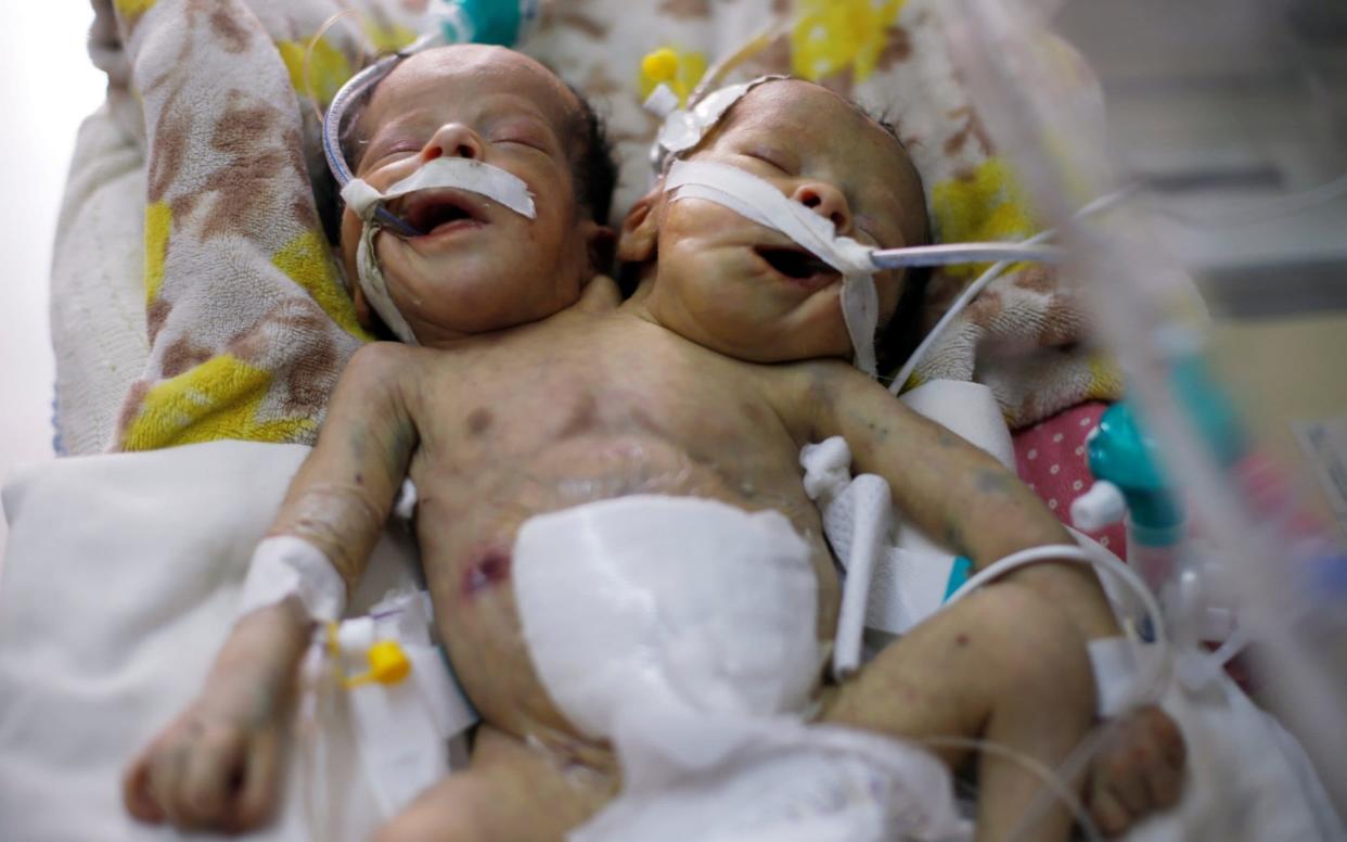 Newly born conjoined twins lie in an incubator at the child intensive care unit of al-Thawra hospital in Sanaa, Yemen  - Reuters