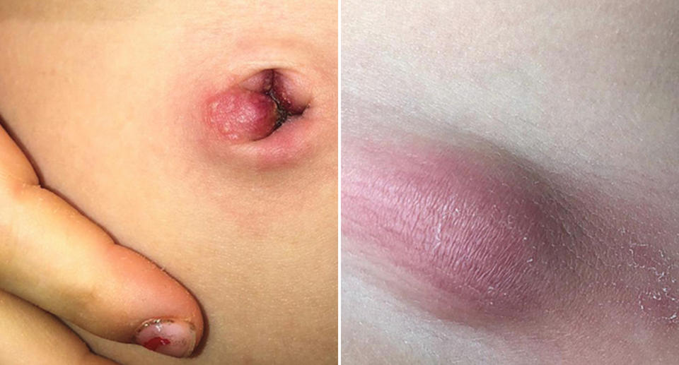 Two photos of a five-year-old girl's stomach. One shows a small red bump on her belly button where a tick was removed and another shows a swelling.