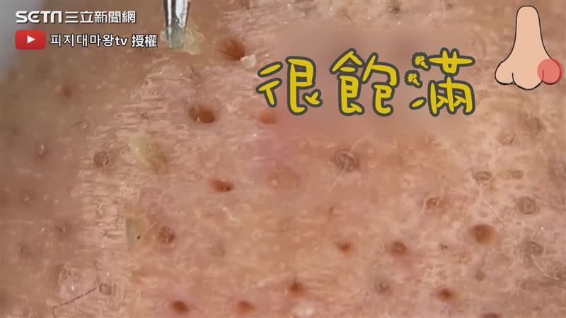 美容師拔出各種形狀的皮脂管絲和粉刺。（圖／피지대마왕tv 授權）