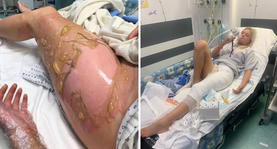 Hot water bottle injury; Sydney Westcott in hospital bed