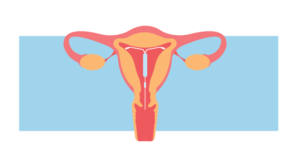 Normal sensations after IUD insertion are cramping, slight lower back pain, and even some light bleeding.