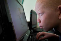 <p>Mwigulu Magesaa 14, a Tanzanian with albinism who had an arm chopped off in a witchcraft-driven attack, looks at a computer screen at the Global Medical Relief Fund house in the Staten Island borough of New York City, June 2, 2017. (Photo: Carlo Allegri/Reuters) </p>