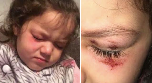 Ellise Collin said a laundry pod exploded in her four-year-old's eye. Photo: Facebook/ Ellise Collin