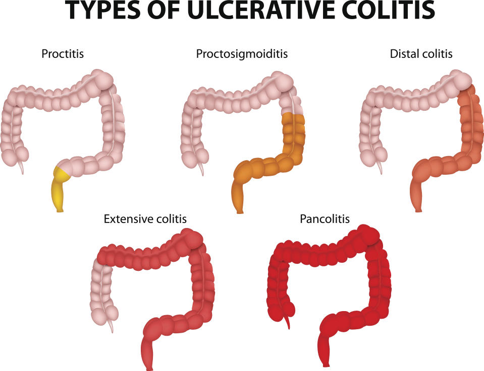 Tipos de colitis ulcerosa (CU). El diagrama muestra los tipos de CU, desde la proctitis (que involucra solo el recto) hasta la pancolitis (que involucra todo el colon). Si afecta hasta el primer ángulo del colon (ángulo esplénico) se llama colitis izquierda y cuando afecta a todo el colon recibe el nombre de pancolitis. (Imagen: Getty)